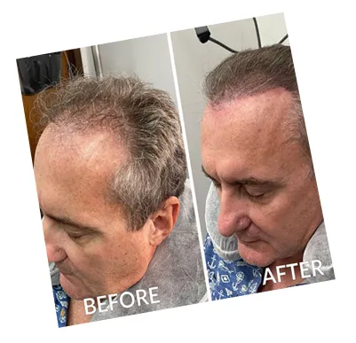 CASE CLOSED: Traction Alopecia — Reactivated Follicles in 6 Months